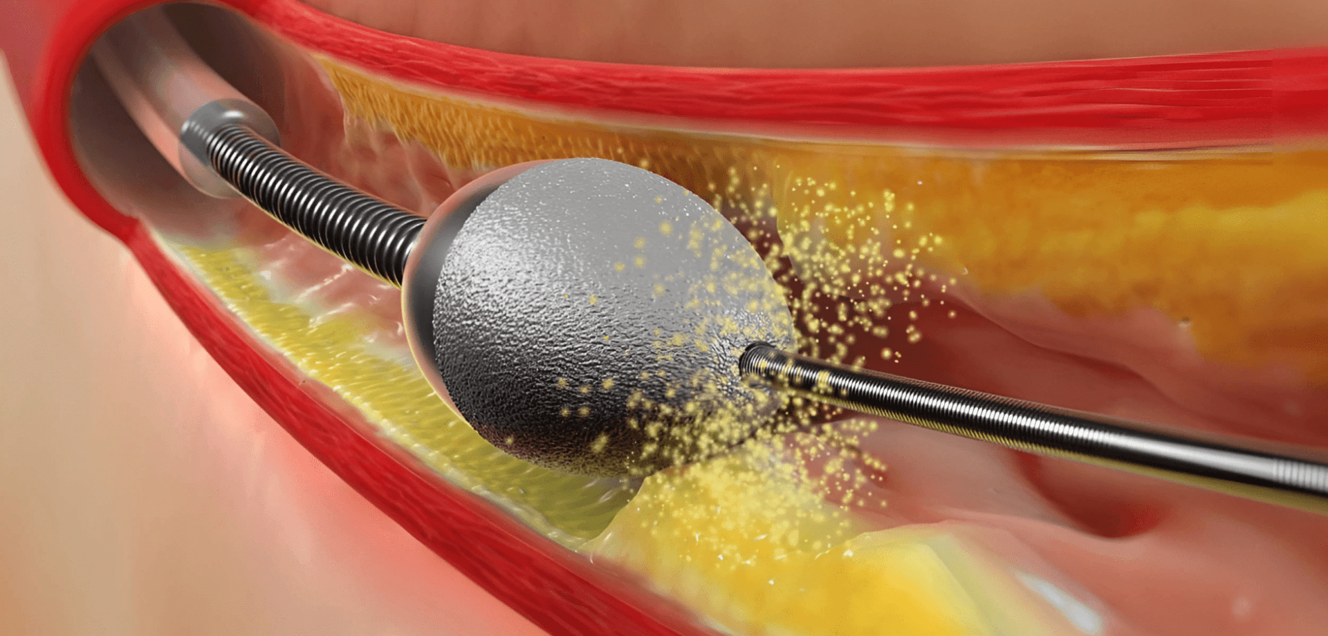 Rotational Atherectomy: A Modern Breakthrough for Treating Stubborn Heart Blockages