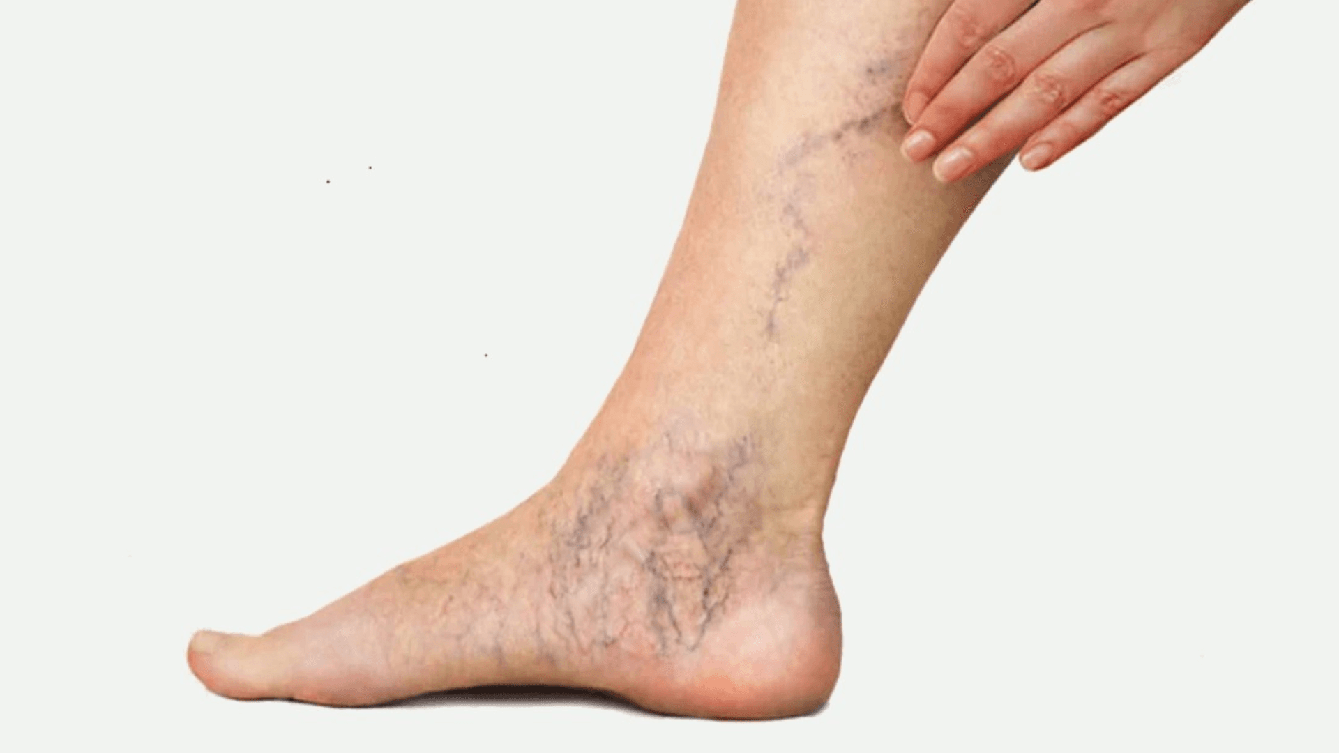 Varicose Veins: What They Really Mean and Why They Appear
