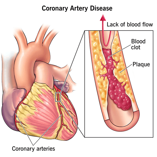Coronary Artery Disease Clinic