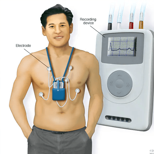 Holter Monitoring