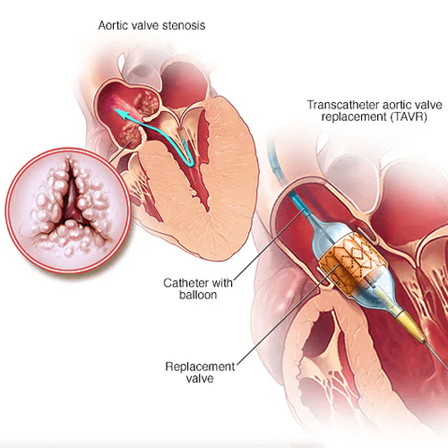 Prosthetic Valve Clinic