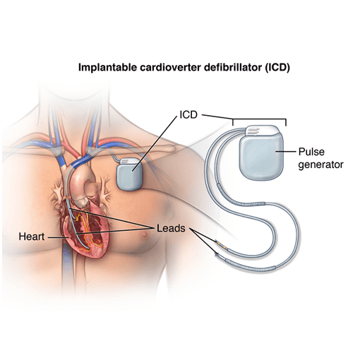 AICD Implantation