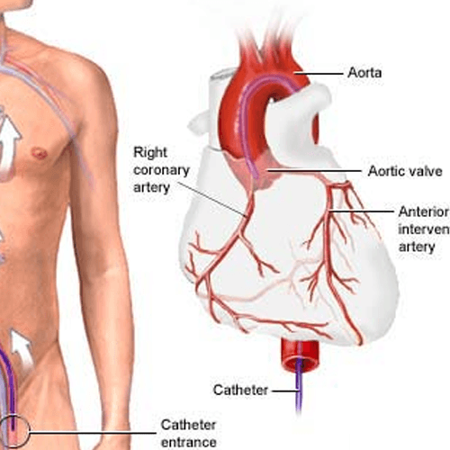 Coronary Angiography