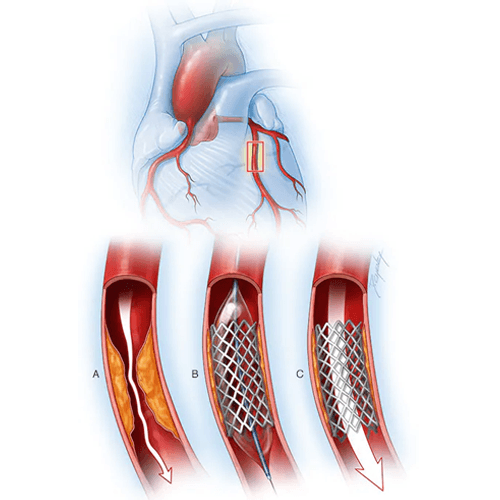 Coronary Angioplasty