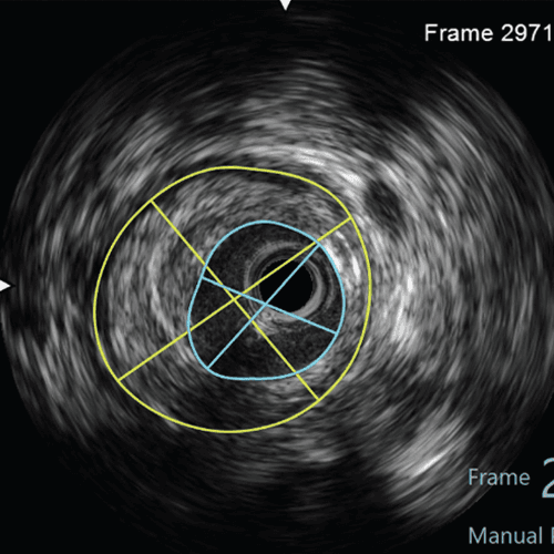 PTCA Under Guidance of IVUS