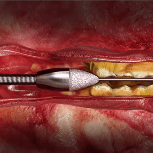 Rotational Atherectomy