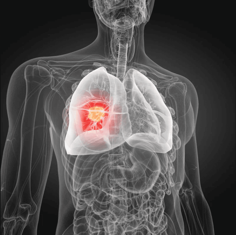 Lung Cancer Treatment